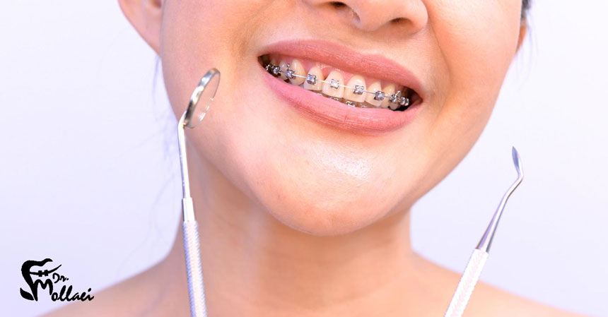 از براکت‌های سرامیکی هم برای انجام ارتودنسی‌های ثابت استفاده می‌شود. ازآنجایی‌که این براکت‌ها تقریباً هم‌رنگ دندان‌ها هستند از زیبایی ظاهری بیشتری نسبت به سایر انواع ارتودنسی ثابت برخوردار است.