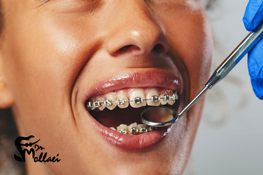 ارتودنسی ثابت یکی از روش‌های درمان ناهنجاری‌ها و مشکلات فک و دندان‌هاست که از آن برای صاف‌کردن و هم‌ردیف کردن دندان‌ها استفاده می‌شود.