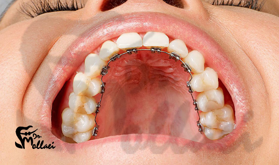 در ارتودنسی لینگوال برخلاف سایر روش‌های ارتودنسی، براکت‌ها در سطح پشتی دندان‌ها چسبیده می‌شوند. 