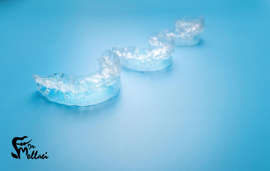 نگهدارنده‌ها ابزاری هستند که بعد از ارتودنسی برای حفظ موقعیت جدید دندان‌ها به کار می‌روند.
