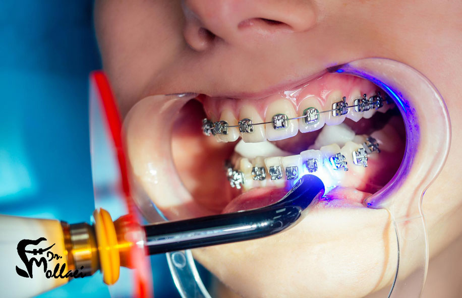 ارتودنسی به عنوان راه حلی موثر برای مرتب کردن دندان‌ها شناخته می‌شود، اما طولانی بودن دوره درمان، یکی از دغدغه‌های رایج در این زمینه است.