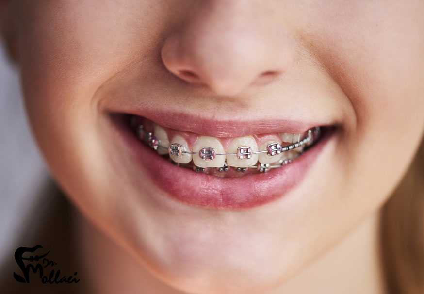 پیچیدگی و شدت ناهنجاری دندانی، نقشی اساسی در مدت زمان درمان ارتودنسی ایفا می‌کند.