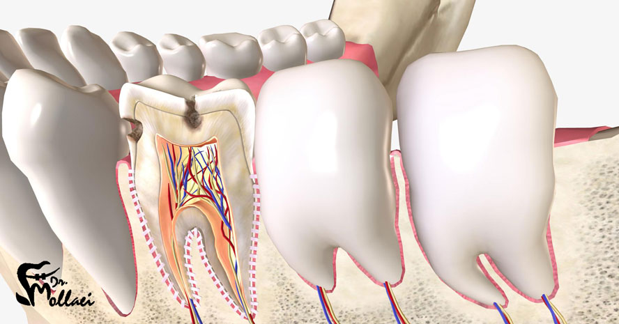در برخی موارد، ممکن است قبل از شروع ارتودنسی، نیاز به عصب کشی دندان وجود داشته باشد. 