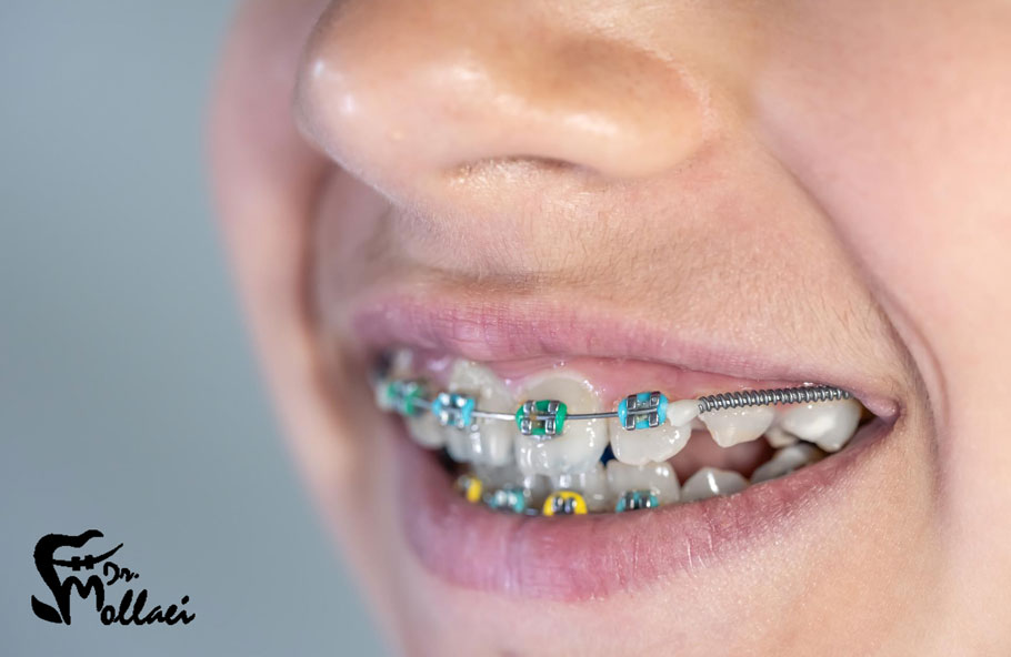 فرق ارتودنسی متحرک با ثابت، ارتودنسی ثابت، روشی برای مرتب کردن دندان‌ها است که از طریق چسباندن براکت‌های فلزی یا سرامیکی به دندان‌ها و اتصال آنها به یک سیم فلزی انجام می‌شود. 