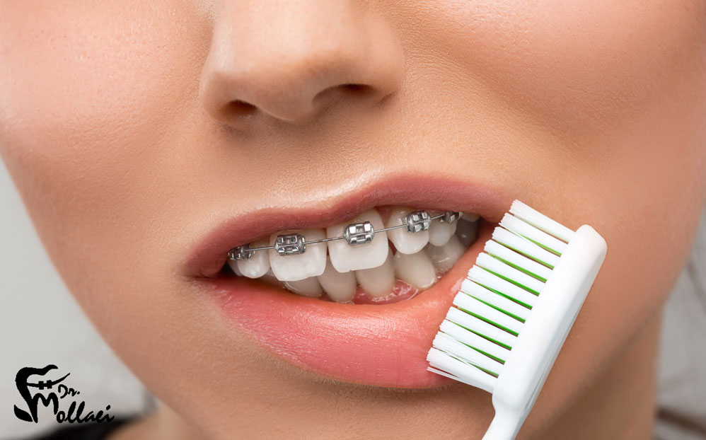 سوالی که بسیاری از افراد می‌پرسند این است که آیا ارتودنسی بدون کشیدن دندان عقل امکان‌پذیر است؟