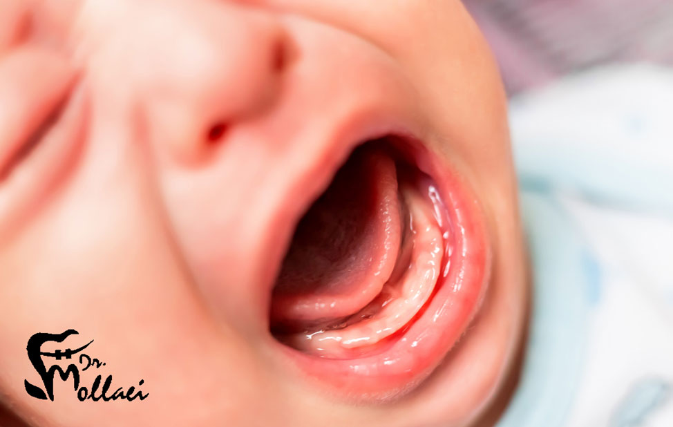 خطرات تاول دهان در کودکان