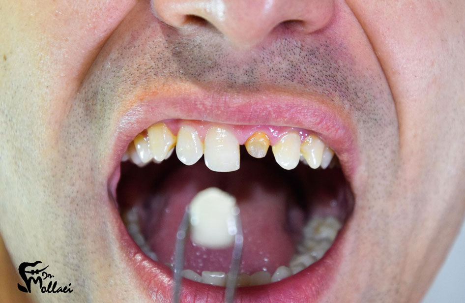 لمینت برای مرتب کردن دندان بدون ارتودنسی