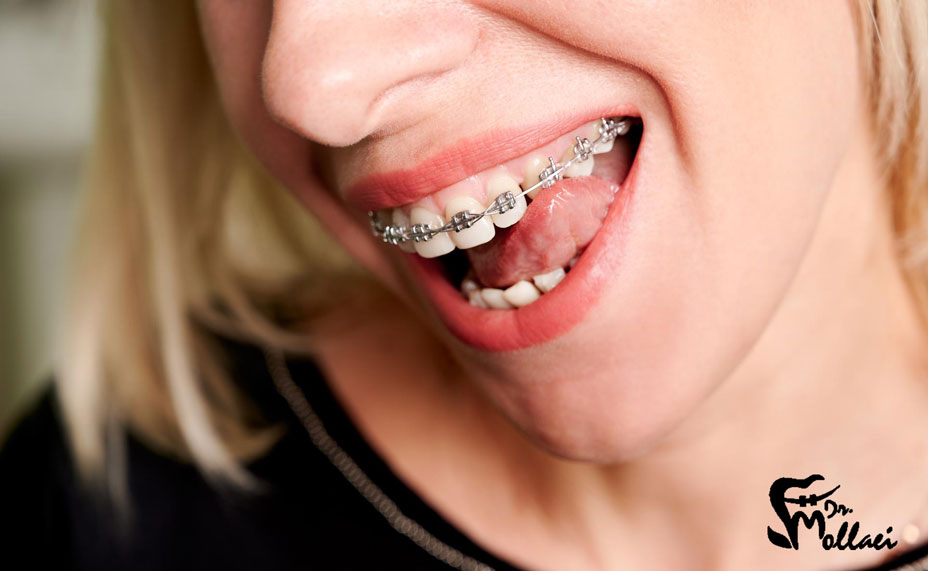 به طور کلی، کشیدن دندان عقل قبل از ارتودنسی در موارد زیر ضروری است