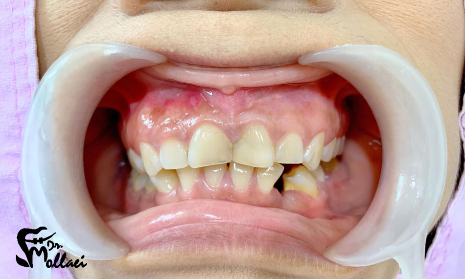 آیا دندان نهفته برای سلامت دندان و دهان ضرر دارد؟