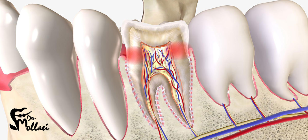 دلیل درمان دوباره دندان عصب کشی شده چیست؟