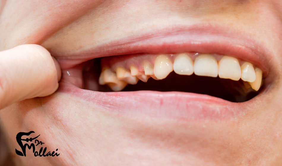 علائم دندان نهفته چیست؟
