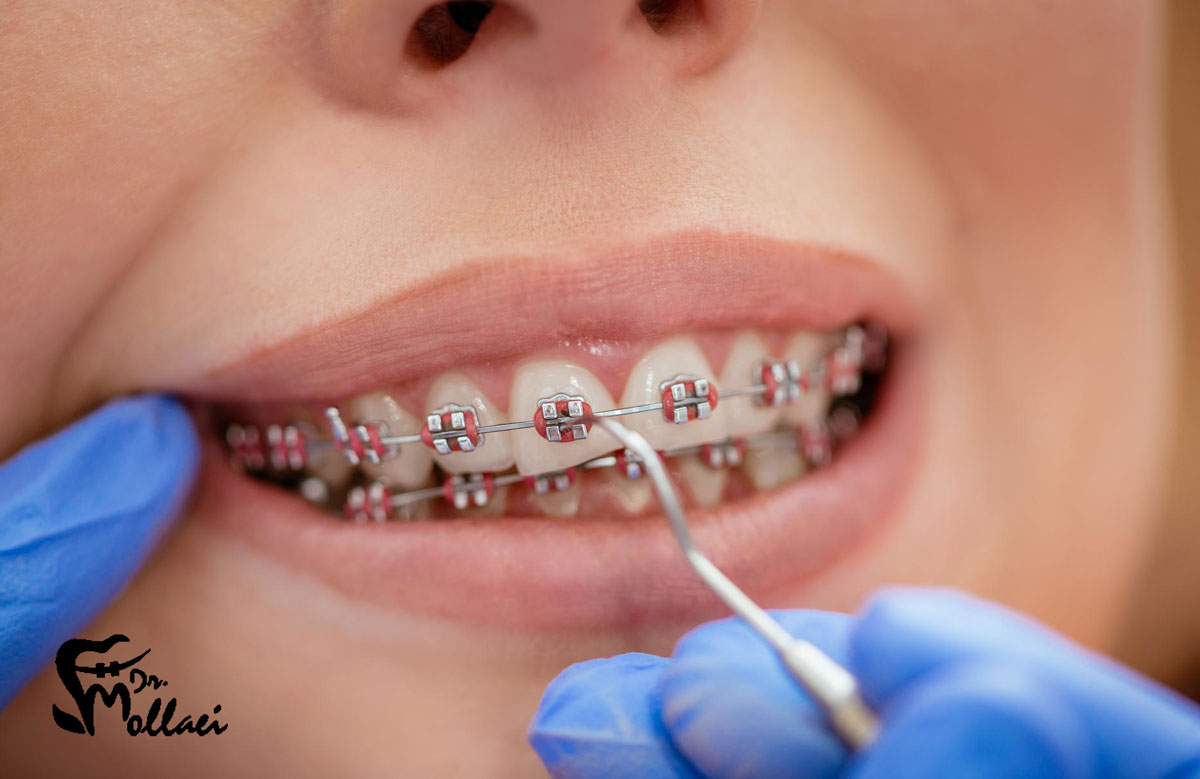 نکات ساده برای تمیز کردن دندان ارتودنسی