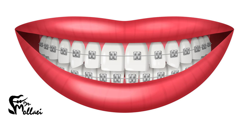 روش های ارتودنسی برای از بین بردن فاصله بین دندان ها
