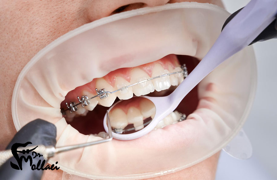 ارتودنسی دیمون