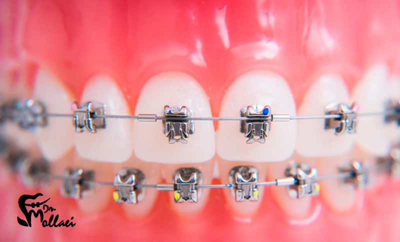 ارتودنسی چقدر باید روی دندان بماند؟ به طور میانگین، درمان ارتودنسی بین 18 تا 36 ماه طول می‌کشد.