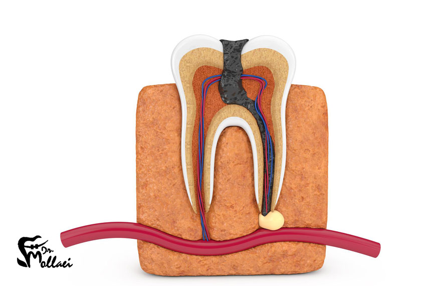 ارتودنسی روی دندان عصب‌کشی شده امکان‌پذیر است