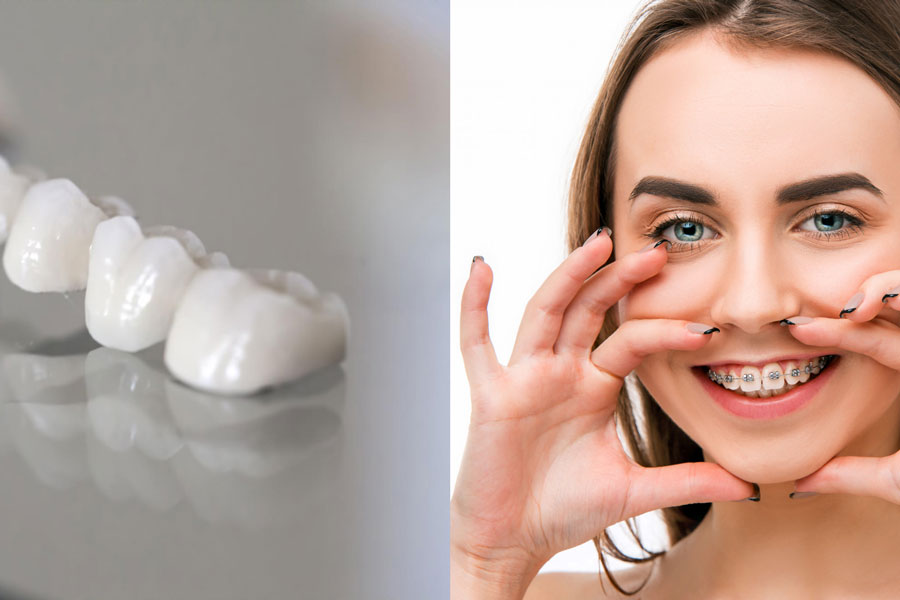 لازم است با یک دندانپزشک متخصص مشورت کنید و فرق ارتودنسی با کامپوزیت بشناسید.