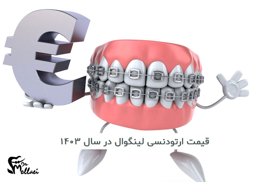 ارتودنسی لینگوال یا پشت دندانی، به عنوان راه حلی جایگزین و نامرئی، محبوبیت زیادی پیدا کرده است.