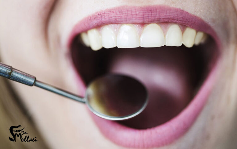 مرتب کردن دندان بدون ارتودنسی
