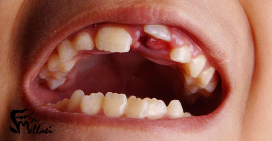 دندان نهفته چیست؟