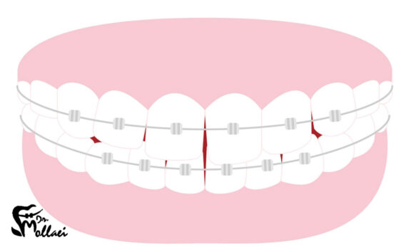 از بین بردن فاصله دندان چیست؟