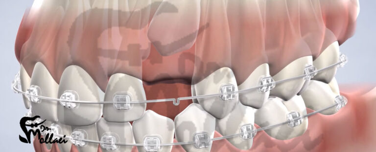هزینه ارتودنسی دندان نیش نهفته