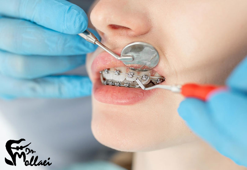 هزینه ارتودنسی