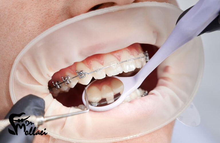 ارتودنسی دیمون