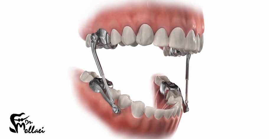 ارتودنسی فانکشنال