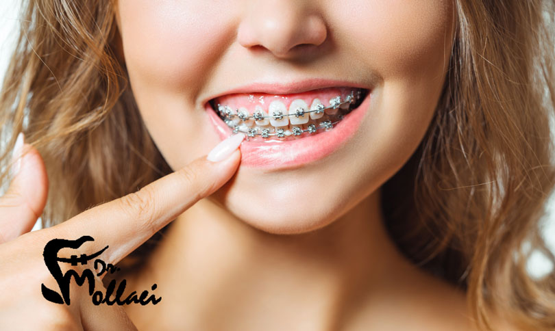 ارتودنسی متحرک