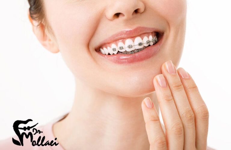 ارتودنسی نامرئی