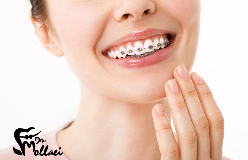 ارتودنسی نامرئی